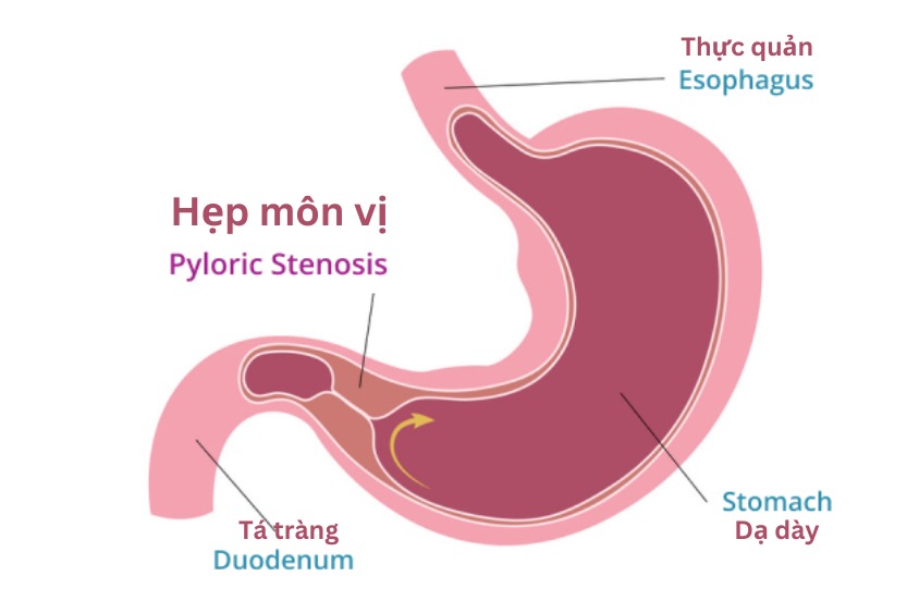 Hẹp môn vị 1