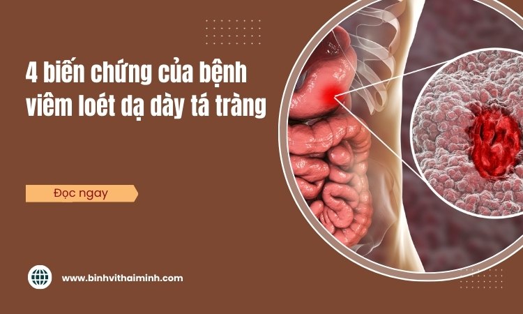 4 Biến chứng nguy hiểm của viêm loét dạ dày tá tràng