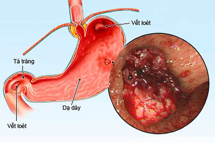 8. Viêm loét dạ dày 1