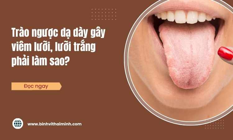 Trào ngược dạ dày gây viêm lưỡi, lưỡi trắng phải làm sao?