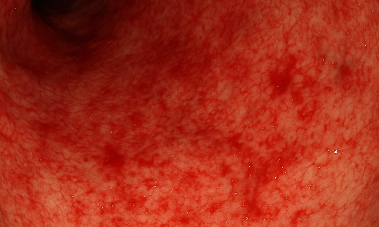 Viêm dạ dày xung huyết có nguy hiểm không? 1