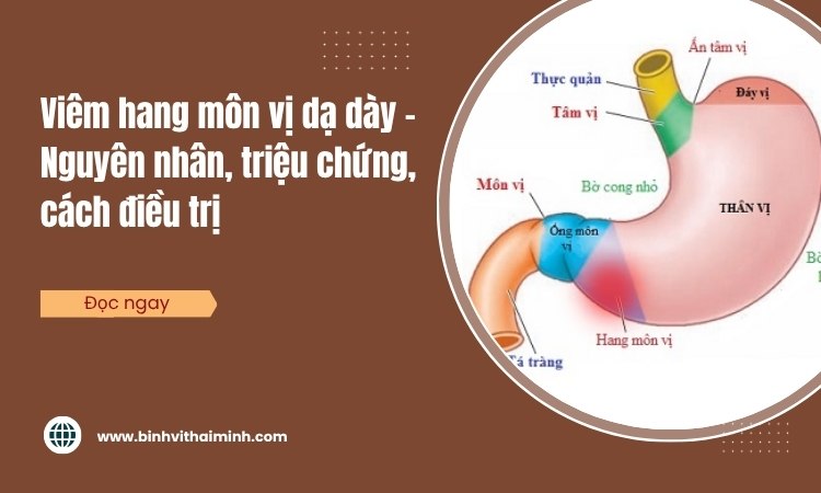Viêm hang môn vị dạ dày – Nguyên nhân, triệu chứng, cách điều trị