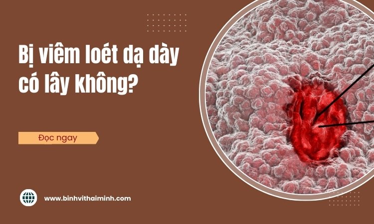 Bị viêm loét dạ dày có lây không?