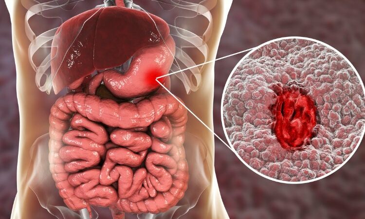 Biến chứng trào ngược dịch mật gây ra là gì? 1