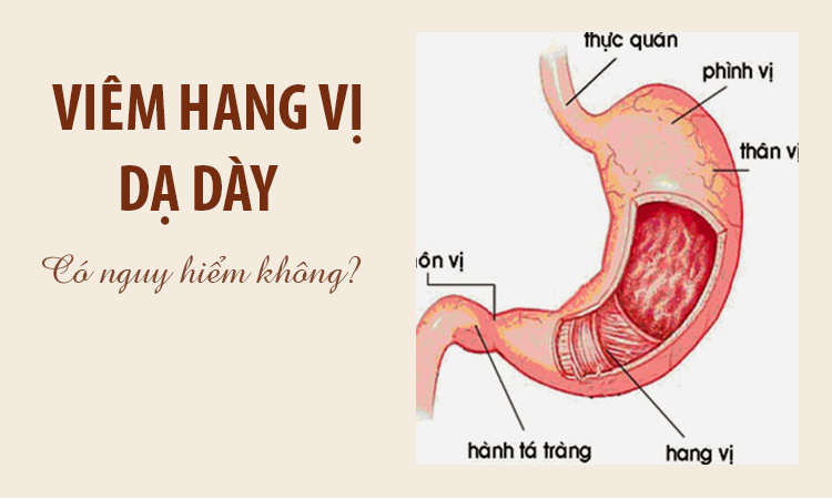 Viêm hang vị dạ dày có nguy hiểm không – Giải đáp chi tiết!