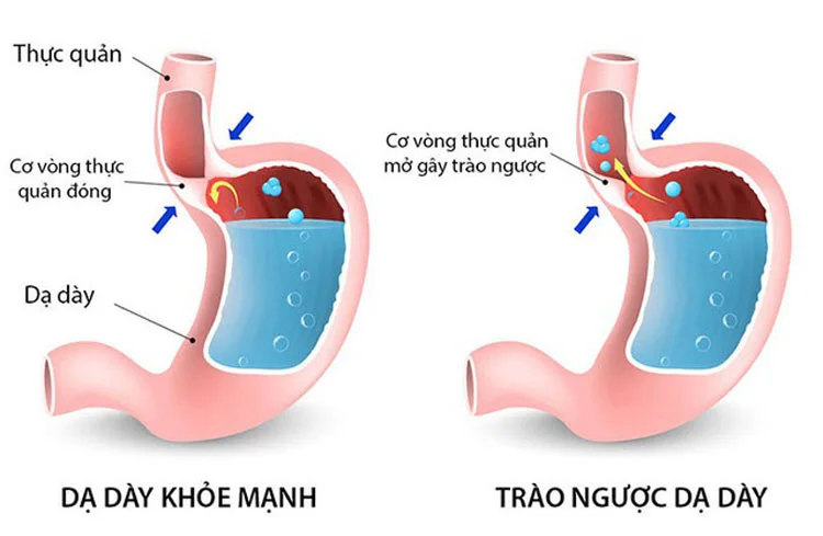 Viêm loét dạ dày, vi khuẩn HP - Giải pháp nào cho người bệnh?