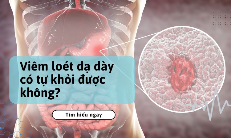 viêm loét dạ dày có tự khỏi được không